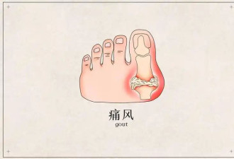 得了痛风一口肉都不能吃？看看专家怎么说