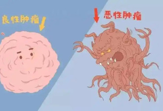 早期癌症“入侵”时 血常规或有5处异常