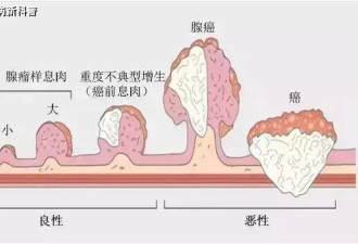 我偶然查出肠癌 怎么一点症状都没有？