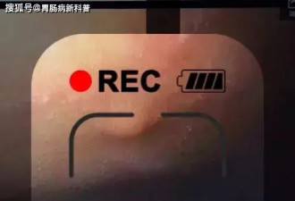 我偶然查出肠癌 怎么一点症状都没有？