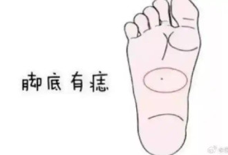 脚底有痣注定成就不凡？四肢的色素痣更易恶变