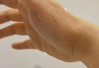 穆婷婷针灸治疗旧伤，身上插近20根长针，痛到把手咬出牙印
