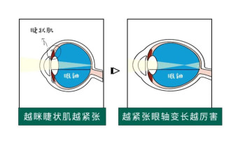 近视的人不戴眼镜，时间久了会怎么样？