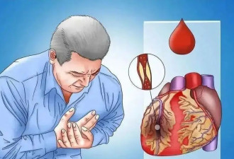 警惕心肌梗死的十个高危时刻