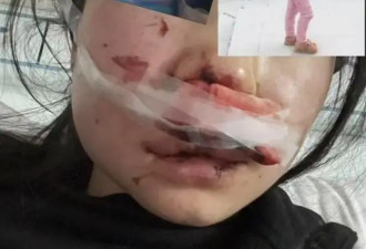 女孩称跨年夜有人朝人群扔“战神鞭炮”,面部被炸