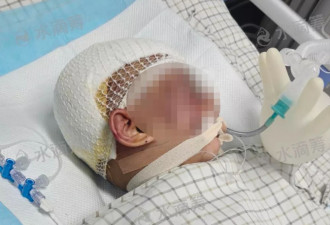云南3岁女童被狗群撕咬缝合300多针，仍昏迷