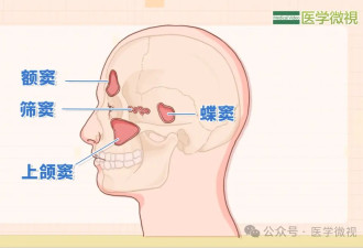 反复头痛 一查鼻子竟“发霉”了