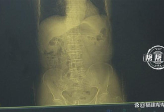 夫妻双双确诊癌症 只因数十年同一个习惯