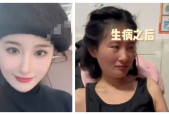 26岁美女确诊渐冻人症 1年间容貌巨变判若两人 曾一度想要轻生