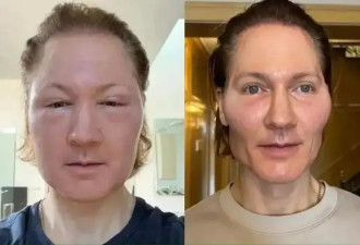 47岁硅谷富豪花几千万变嫩，却变老20岁，面部“姨化”油腻…