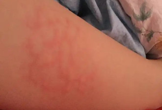 皮肤上的总出血的红色肿物会是癌吗？
