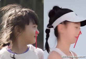 17岁森碟缩到脖子里的下巴，还有机会长出来吗？