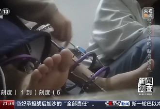 术后麻烦不断 禁而不止的“断骨增高” 有多坑？