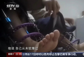 术后麻烦不断 禁而不止的“断骨增高” 有多坑？
