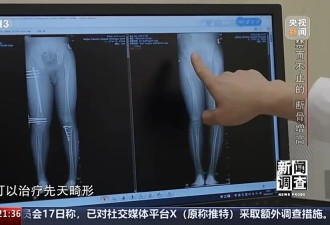 术后麻烦不断 禁而不止的“断骨增高” 有多坑？