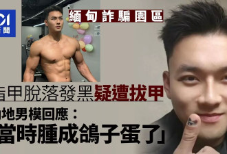 比剃头更惨！中国男模妙瓦底获释 指甲脱落疑遭拔甲