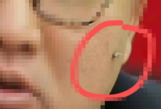 身上长出这种小肉揪，千万别抠！小心越长越多