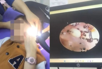 女童投诉耳朵痛 医生发现 耳蜗藏大量跳蚤