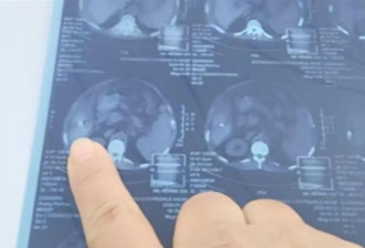 癌症病人做手术针头落体内，院方：建议不取...