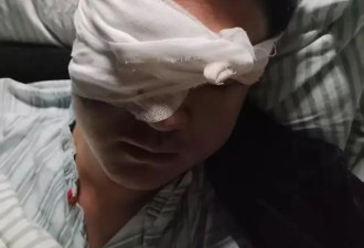 男子逛街遭烟花炸伤眼球被摘除，肇事者暂未找到