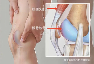 走路时突然“腿一软” 不一定是缺钙