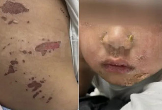 3岁童吃火锅烫伤嘴角 竟全身多处溃烂