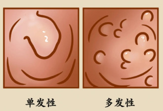 5个因素容易患胃息肉：及时筛查 小心癌变