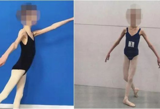 17岁芭蕾少女“瘦成皮包骨”只剩27公斤！爸妈被判入狱