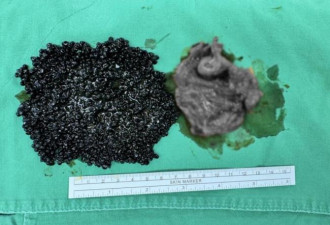 女吃火锅胆结石发炎 打开胆囊见大量”鱼子酱“