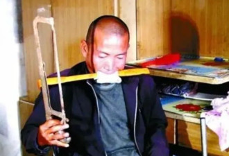 河北硬汉郑艳良自行锯掉右腿，结局怎样