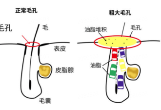 皮肤出油怎么办？如何拥有清爽肌肤