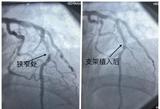 别不当回事！男子牙疼数日，没想到是心肌梗死……