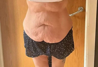 四孩妈飞土耳其整形 一觉醒来 肚子中间留下巨坑