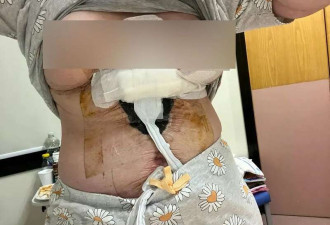 四孩妈飞土耳其整形 一觉醒来 肚子中间留下巨坑