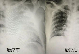 男子“吃鸽”险丧命 这种隐藏的“禽传病”需警惕
