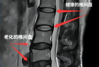腰好竟和椎间盘颜色有关？3个好习惯让它颜色好