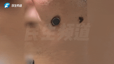 现实版“万磁王”？男子的脸竟能吸住磁铁！