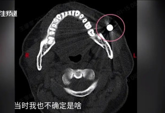 现实版“万磁王”？男子的脸竟能吸住磁铁！