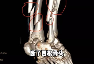500万粉丝女网红滑雪摔断4根骨头！打24个钉子