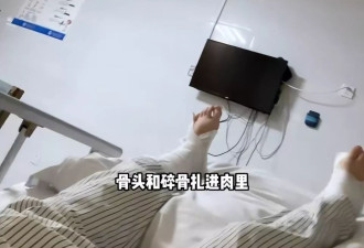 500万粉丝女网红滑雪摔断4根骨头！打24个钉子