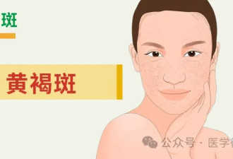 面部常见的三种黑色色素斑 均与日晒有关