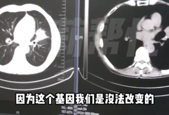 家族9人患癌8人离世 几代人都有这个坏习惯