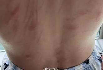 戚薇承认了！张檬哭求“别整容”！肉毒素频翻车，你还敢跟风吗？