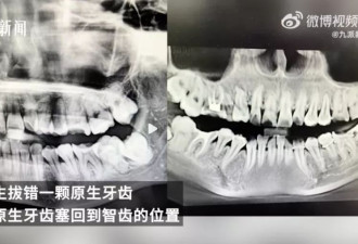 女子疑因“拔错智齿又被塞回”坠楼身亡，多方发声