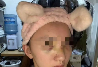 “面部骨折，险些毁容”，成都一女子在游戏馆意外高坠
