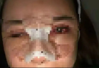 她割双眼皮后眼睛竟闭不起来 苏州医美诊所老板判监半年
