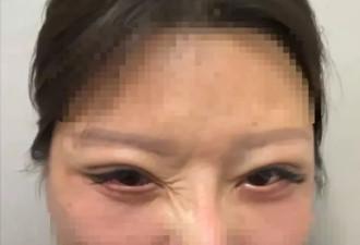 她割双眼皮后眼睛竟闭不起来 苏州医美诊所老板判监半年