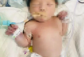 羊水粪染致男婴出生即脑死亡 家属认为医院处置不当