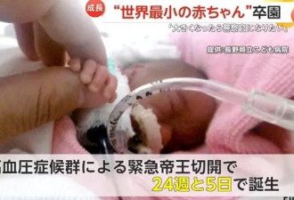 全球最轻男婴:出生仅半斤重 手掌大 已顽强长大