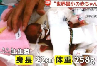 全球最轻男婴:出生仅半斤重 手掌大 已顽强长大